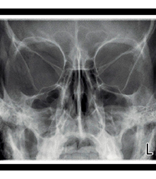 Radiografía de Senos Paranasales