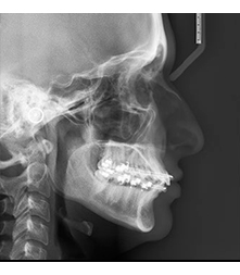 Telerradiografía de Perfil
